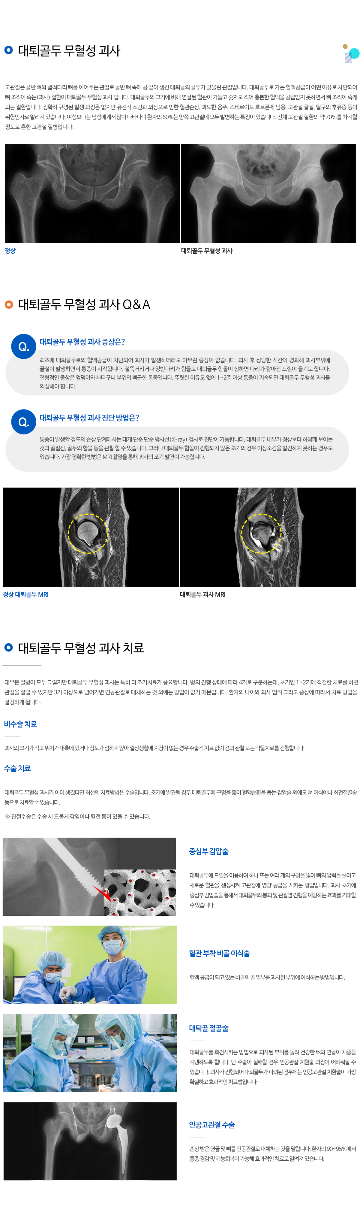 대퇴골두무혈성괴사