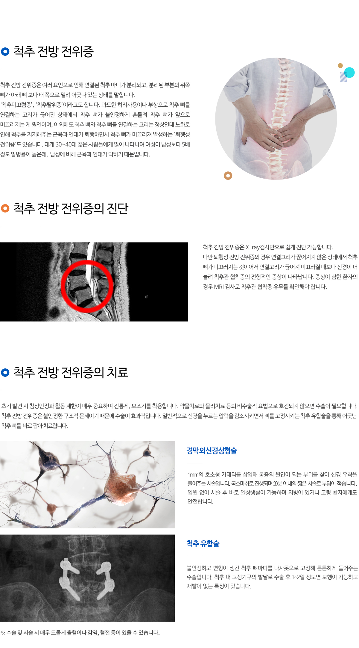 척추전방전위증