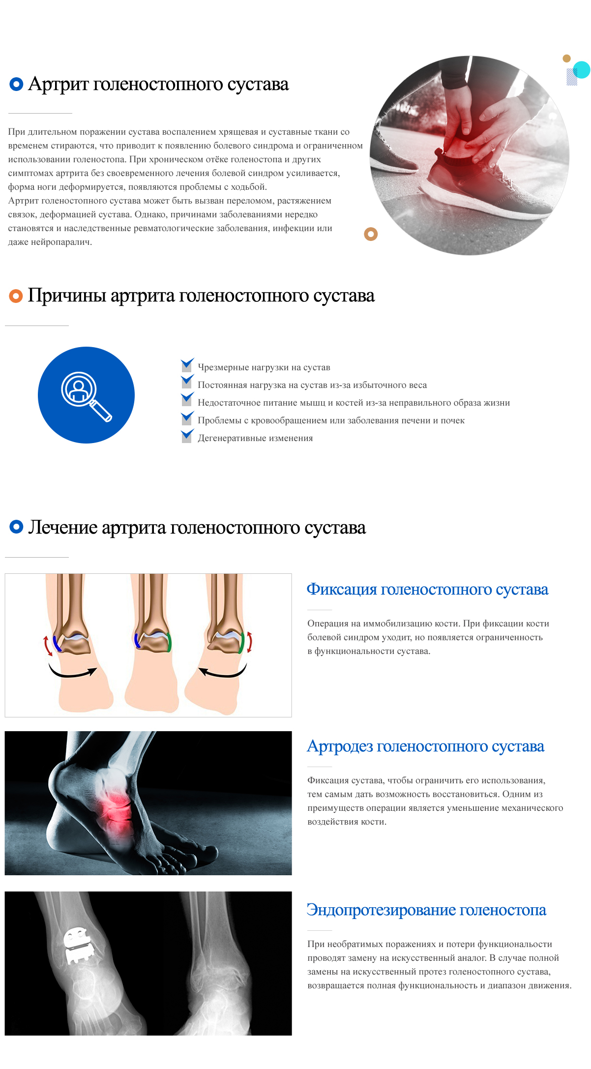 Ankle osteoarthritis